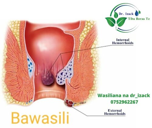 Bawasiri inatibika kiraisi bil