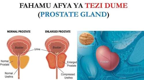 TIBU TEZI DUME BILA UPASUAJI