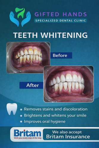TEETH WHITENING
